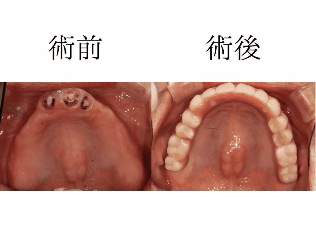 インプラント治療 | 大府市の歯医者・歯科｜RITA歯科